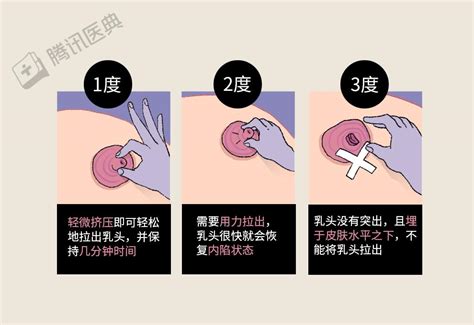 乳暈 長毛|乳頭內凹、長毛正常嗎？ 8類「乳頭形狀」你的是哪種 